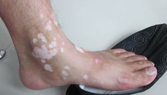 白癜风图片 白癜风图片