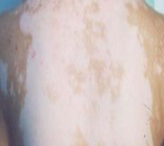 白癜风图片 白癜风图片