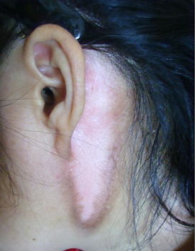 白癜风图片 白癜风图片