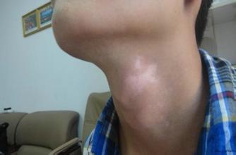 白癜风图片 白癜风图片